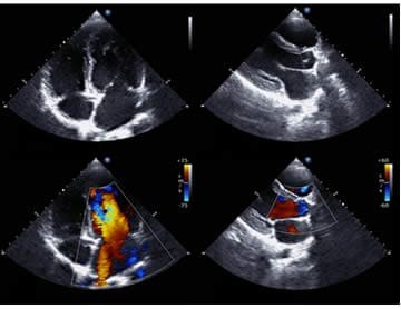 ECOCARDIOGRAFIA TRANSTORACICA, TRANSESOFAGEA E PRINCIPI DIECODINAMICA