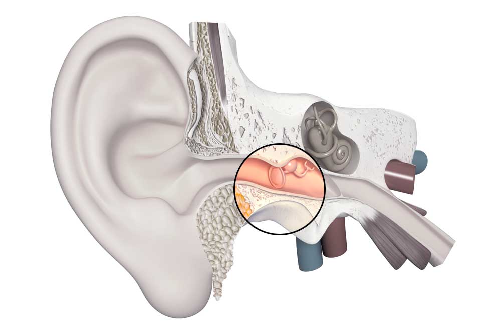 LE IPOACUSIE NELLE VARIE ETA’: DALLA DIAGNOSI PRECOCE DELLE IPOACUSIENEONATALI ALLA PRESBIACUSIA