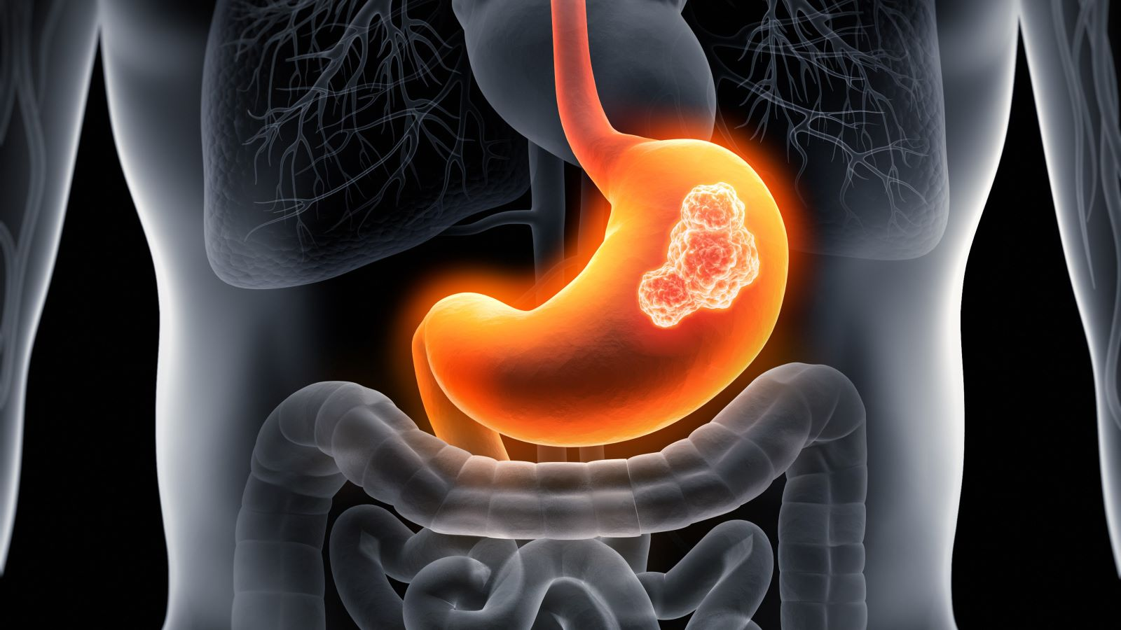 IL CANCRO GASTRICO NEL 2025: STATO DELL’ARTE NELLA DIAGNOSI E NELLATERAPIA